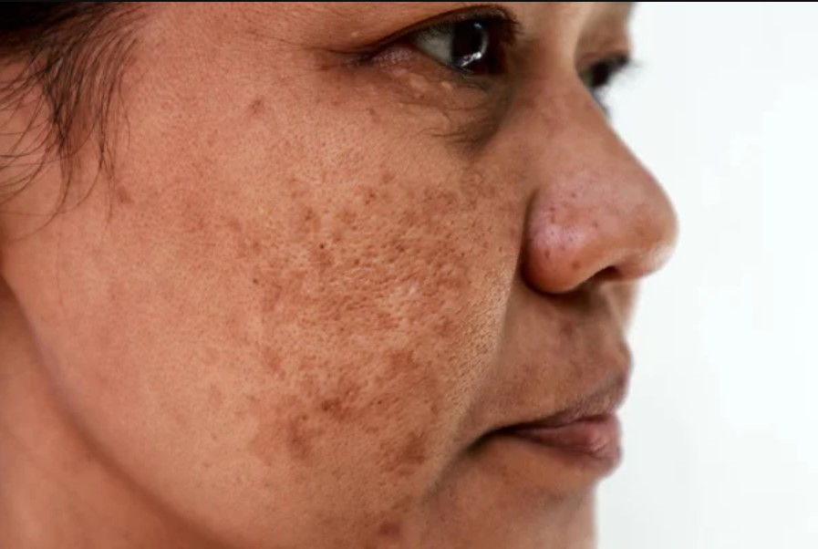 melasma